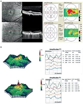 Spectral-domain optical coherence tomography combined with electroretinography in the assessment of conbercept for neovascular age-related macular degeneration: a preliminary study
